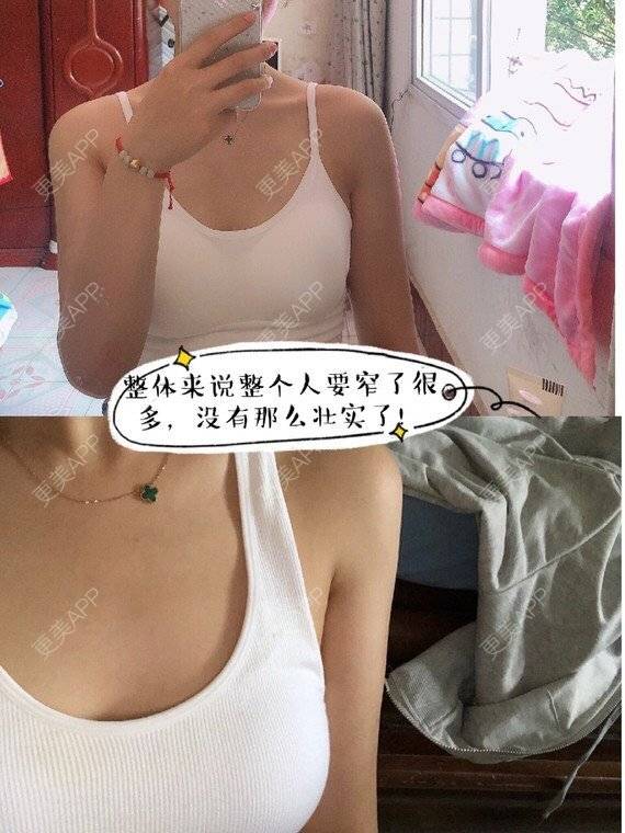 更美 - 叁小妹的背部吸脂经验 | 手臂吸脂 | 背部吸脂 | 成都