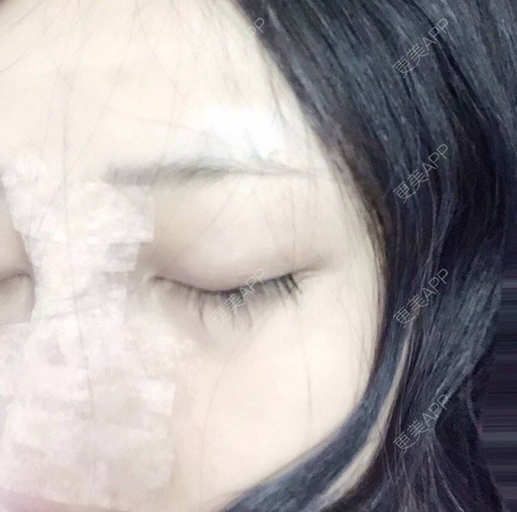 更美 - 更美用户kl269qdr6N的鼻部多项经验 | 鼻部多项 | 手术缩鼻头 | 鼻小柱延长 | 自体软骨垫鼻尖