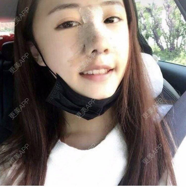 更美 - 更美用户kl269qdr6N的鼻部多项经验 | 鼻部多项 | 手术缩鼻头 | 鼻小柱延长 | 自体软骨垫鼻尖