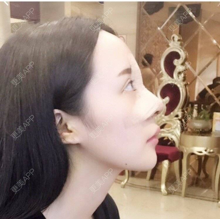 更美 - 更美用户kl269qdr6N的鼻部多项经验 | 鼻部多项 | 手术缩鼻头 | 鼻小柱延长 | 自体软骨垫鼻尖
