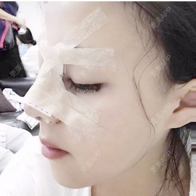 更美 - 更美用户kl269qdr6N的鼻部多项经验 | 鼻部多项 | 手术缩鼻头 | 鼻小柱延长 | 自体软骨垫鼻尖