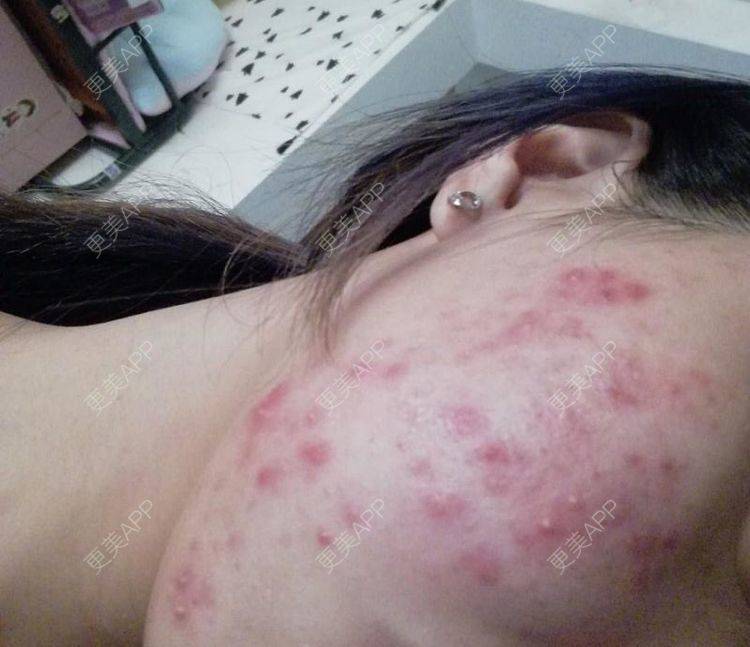 更美用户6triylrigl的祛疤痕痘印日记