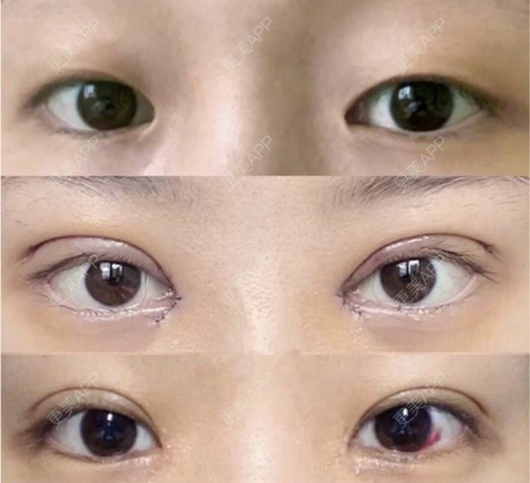 更美 - 更美用户CPq4B1LOBe的双眼皮经验 | 全切双眼皮 | 开内眼角 | 双眼皮 | 宁波