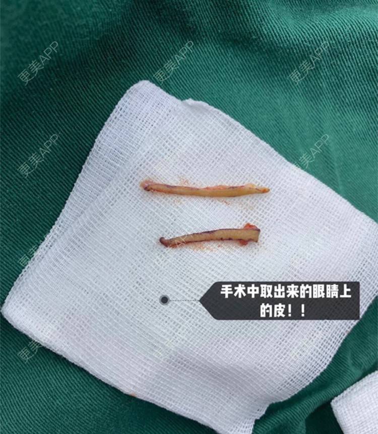 更美 - 更美用户CPq4B1LOBe的双眼皮经验 | 全切双眼皮 | 开内眼角 | 双眼皮 | 宁波