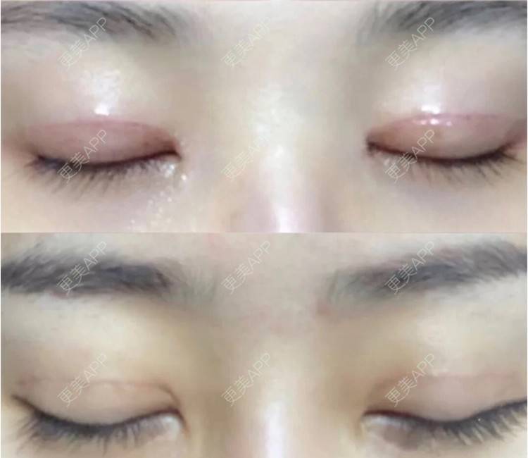 更美 - 更美用户CPq4B1LOBe的双眼皮经验 | 全切双眼皮 | 开内眼角 | 双眼皮 | 宁波