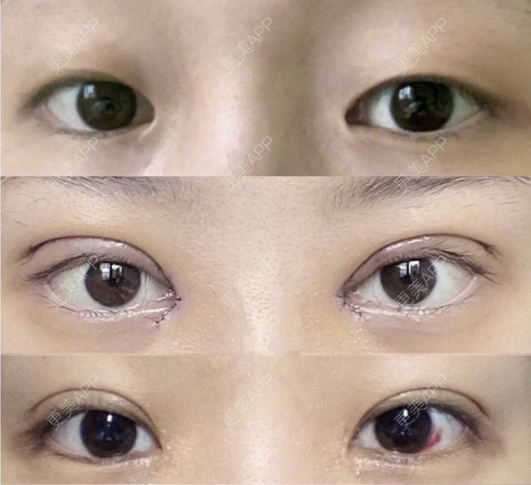 更美 - 更美用户CPq4B1LOBe的双眼皮经验 | 双眼皮 | 全切双眼皮 | 开内眼角 | 宁波