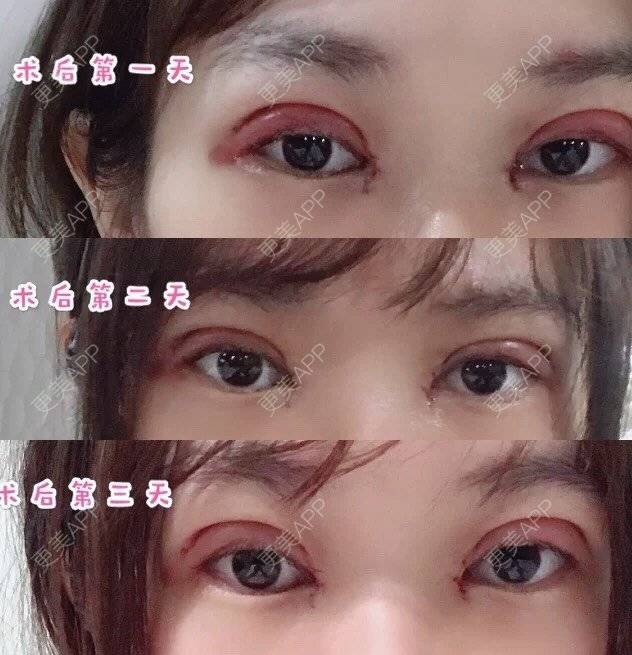 更美 - 更美用户CPq4B1LOBe的双眼皮经验 | 双眼皮 | 全切双眼皮 | 开内眼角 | 宁波