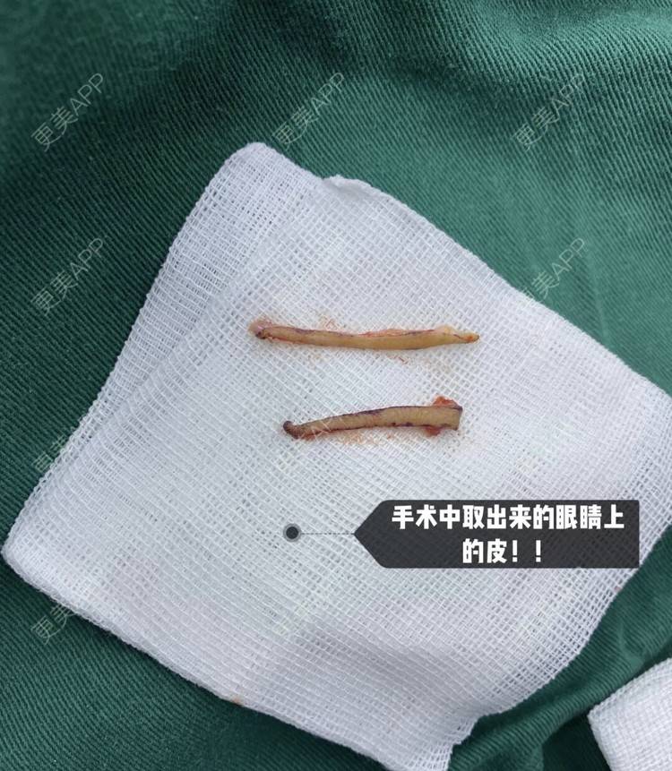 更美 - 更美用户CPq4B1LOBe的双眼皮经验 | 双眼皮 | 全切双眼皮 | 开内眼角 | 宁波
