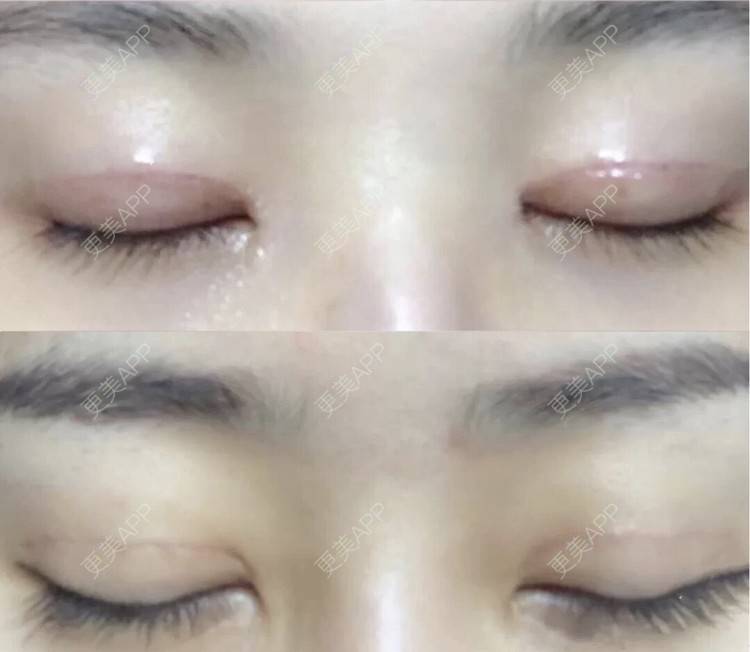 更美 - 更美用户CPq4B1LOBe的双眼皮经验 | 双眼皮 | 全切双眼皮 | 开内眼角 | 宁波
