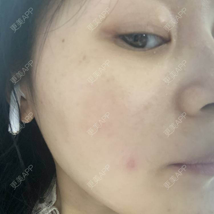 更美 - 一白遮三丑丑丑的激光淡斑经验 | 上海 | 激光淡斑 | 皮秒激光 | 淡斑套餐