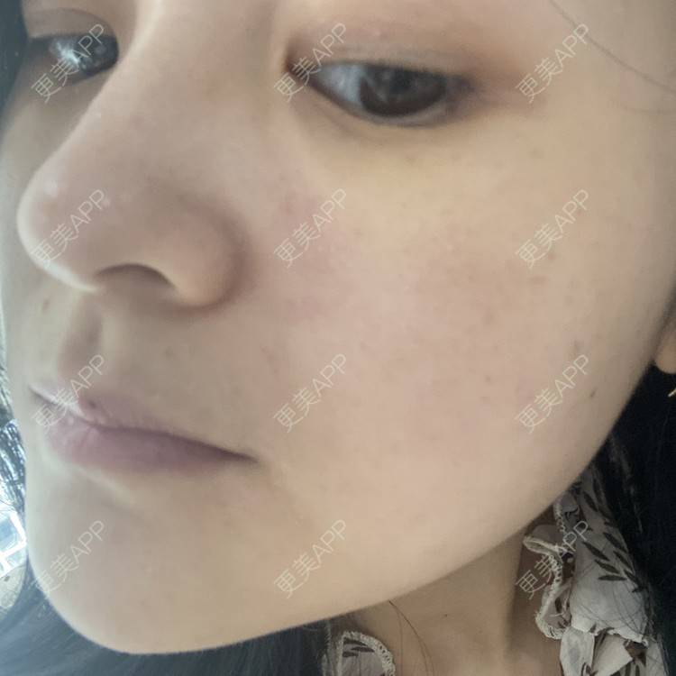 更美 - 一白遮三丑丑丑的激光淡斑经验 | 上海 | 激光淡斑 | 皮秒激光 | 淡斑套餐