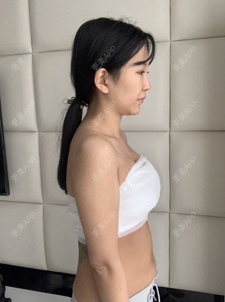 更美 - 更美用户bdmoHq0Aa0的假体隆胸经验 | 假体隆胸