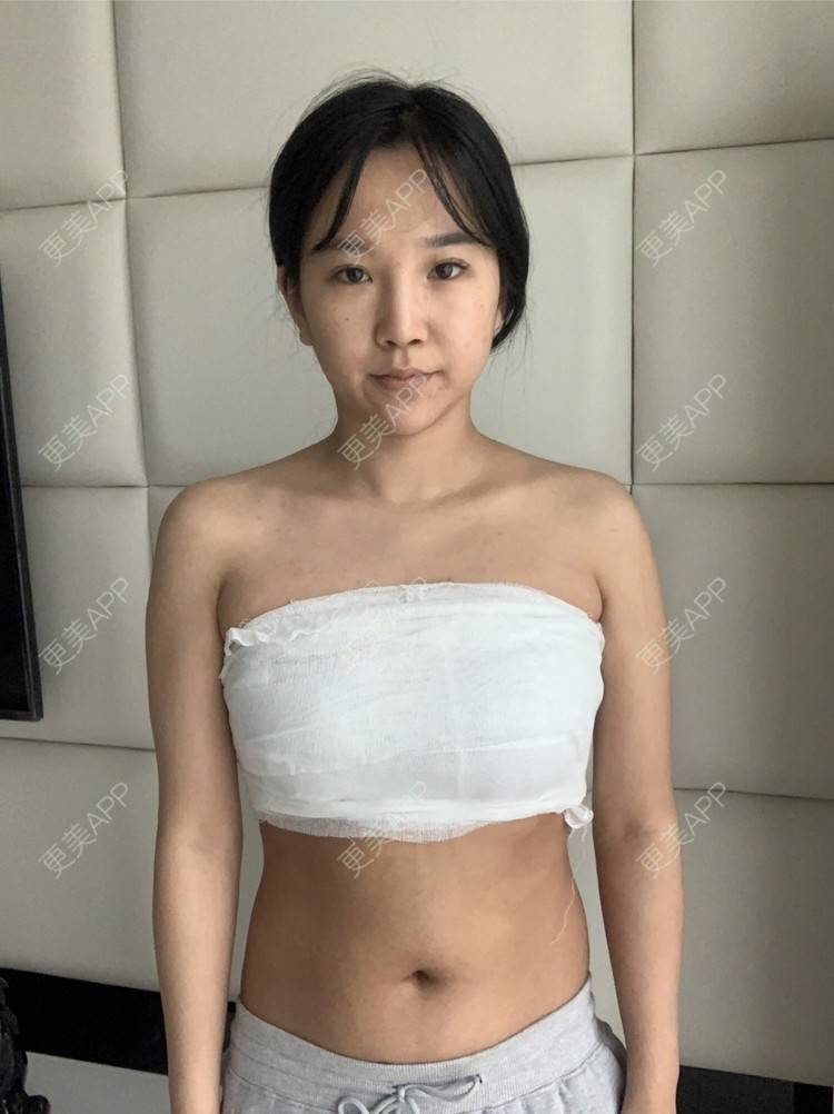更美 - 更美用户bdmoHq0Aa0的假体隆胸经验 | 假体隆胸
