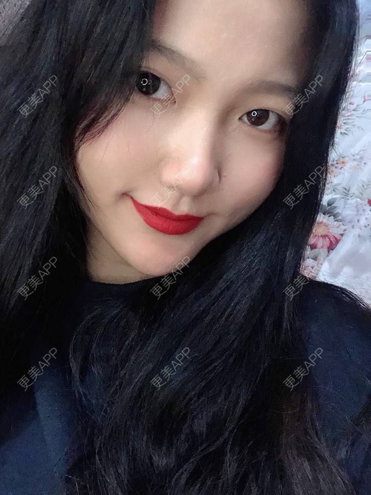 更美 - 男朋友是彭于晏的M唇成形经验 | M唇成形 | 杭州