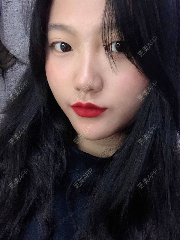 更美 - 男朋友是彭于晏的M唇成形经验 | M唇成形 | 杭州