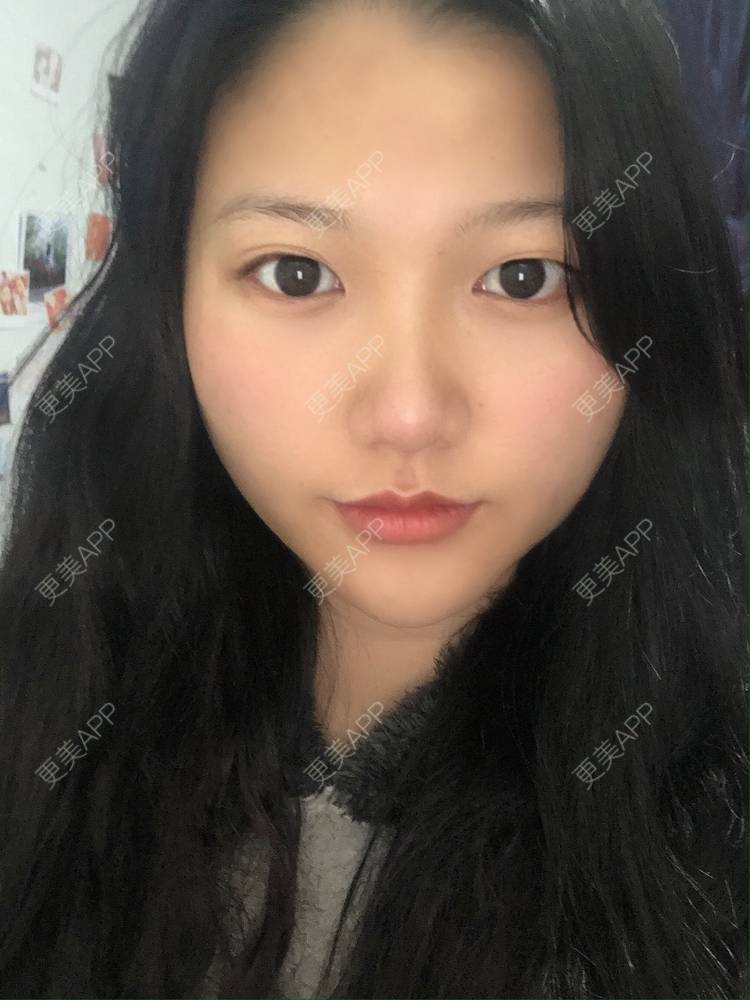 更美 - 男朋友是彭于晏的M唇成形经验 | M唇成形 | 杭州