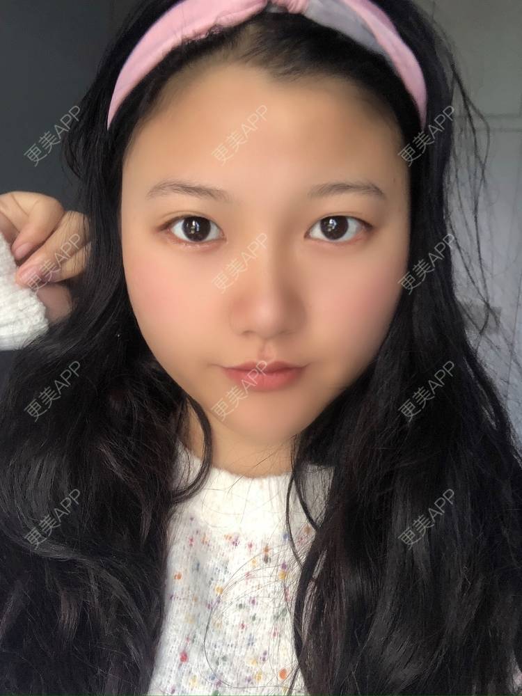 更美 - 男朋友是彭于晏的M唇成形经验 | M唇成形 | 杭州