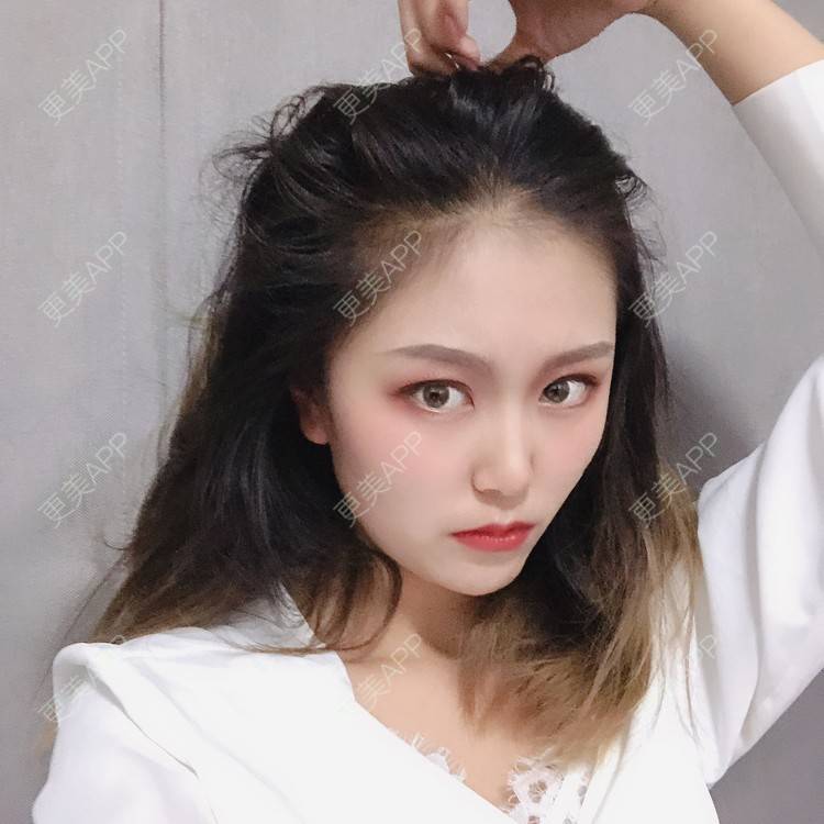 更美 - 更美用户qtK18iJ3fY的朝天鼻矫正经验 | 朝天鼻矫正 | 鼻翼缩小 | 福州 | 人工骨隆鼻 | 真皮隆鼻 | 长鼻矫正