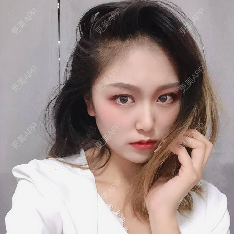 更美 - 更美用户qtK18iJ3fY的朝天鼻矫正经验 | 朝天鼻矫正 | 鼻翼缩小 | 福州 | 人工骨隆鼻 | 真皮隆鼻 | 长鼻矫正