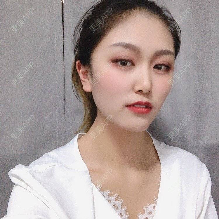 更美 - 更美用户qtK18iJ3fY的朝天鼻矫正经验 | 朝天鼻矫正 | 鼻翼缩小 | 福州 | 人工骨隆鼻 | 真皮隆鼻 | 长鼻矫正
