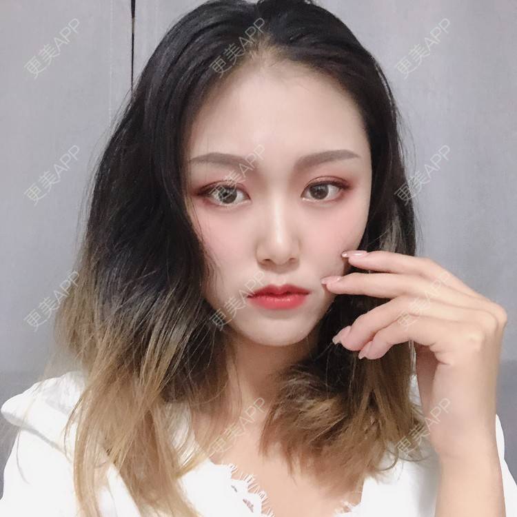 更美 - 更美用户qtK18iJ3fY的朝天鼻矫正经验 | 朝天鼻矫正 | 鼻翼缩小 | 福州 | 人工骨隆鼻 | 真皮隆鼻 | 长鼻矫正