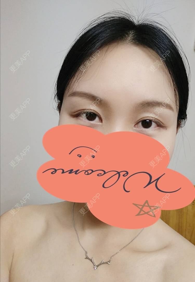 更美 - 更美用户1fHxMDJVIE的眼部多项经验 | 眼部多项 | 广州