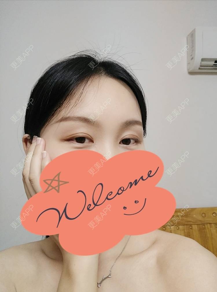 更美 - 更美用户1fHxMDJVIE的眼部多项经验 | 眼部多项 | 广州