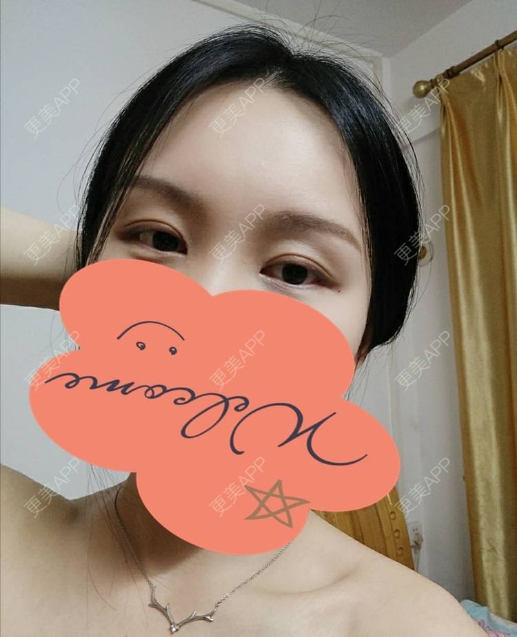 更美 - 更美用户1fHxMDJVIE的眼部多项经验 | 眼部多项 | 广州