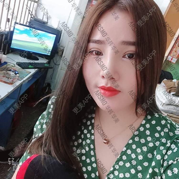 更美 - 初恋网友。的鼻部多项经验 | 鼻部多项 | 鼻部硅胶假体取出 | 耳软骨隆鼻 | 鼻部修复 | 硅胶隆鼻 | 长沙