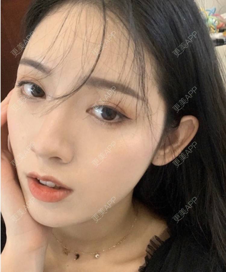 更美 - Zvkk的水光项目经验 | 更美研究所 | 注射美白 | 水光项目 | 杭州
