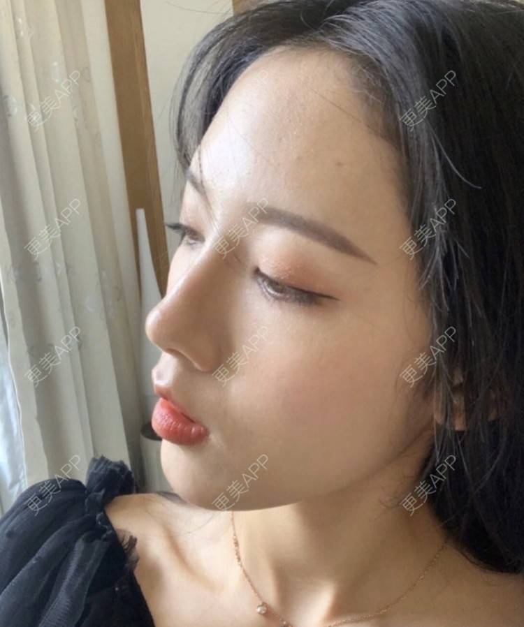 更美 - Zvkk的水光项目经验 | 更美研究所 | 注射美白 | 水光项目 | 杭州