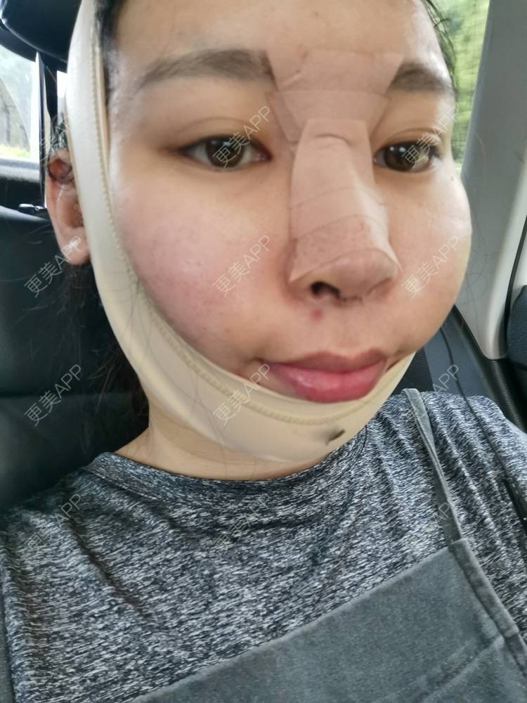 更美 - 胖猪仔77的鼻部多项经验 | 鼻部多项 | 光纤溶脂 | 青岛