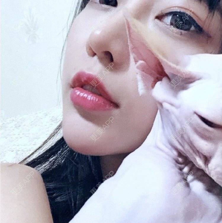 更美 - 节节唔的自体脂肪全面部填充经验 | 更美研究所 | 杭州 | 自体脂肪全面部填充 | 自体脂肪