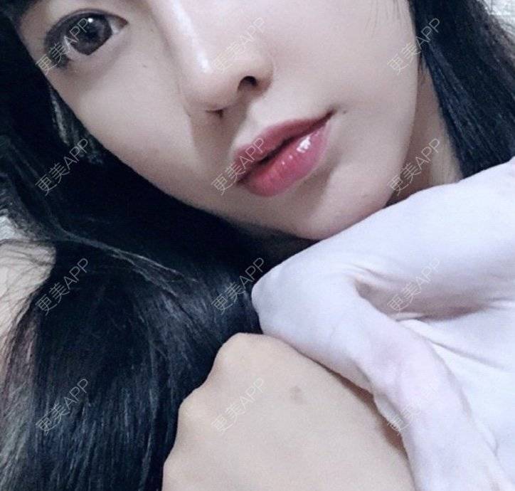 更美 - 节节唔的自体脂肪全面部填充经验 | 更美研究所 | 杭州 | 自体脂肪全面部填充 | 自体脂肪