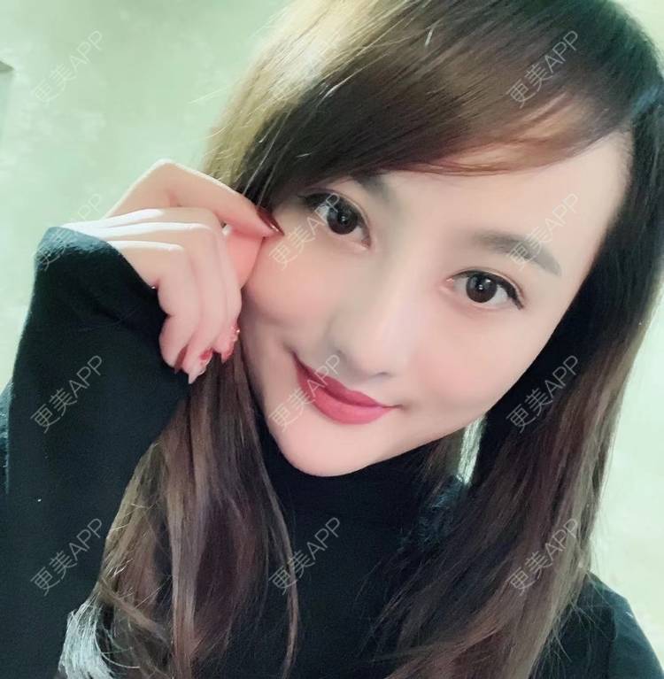 更美 - 更美用户tYzlahBO6T的植发际线经验 | 植发际线 | 深圳 | 毛发移植