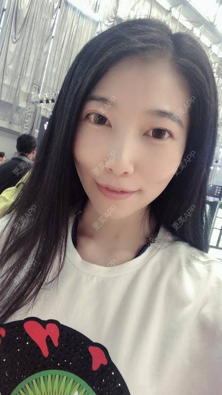 更美 - 摇滚吧姑娘的埋线提升经验 | 埋线除皱 | 昆明 | 埋线提升