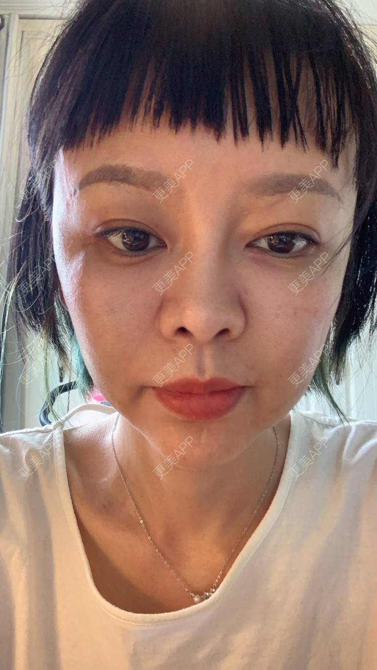更美 - 衣衣丫丫的埋线提升经验 | 埋线提升 | 重庆