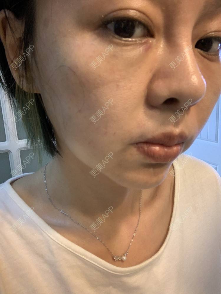 更美 - 衣衣丫丫的埋线提升经验 | 埋线提升 | 重庆