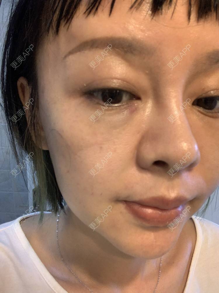 更美 - 衣衣丫丫的埋线提升经验 | 埋线提升 | 重庆