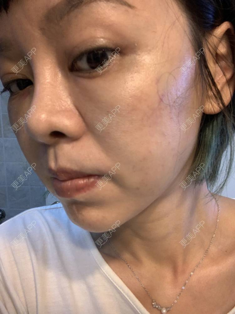 更美 - 衣衣丫丫的埋线提升经验 | 埋线提升 | 重庆
