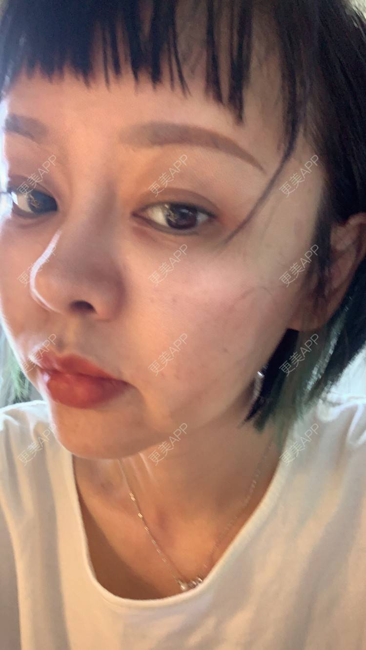 更美 - 衣衣丫丫的埋线提升经验 | 埋线提升 | 重庆