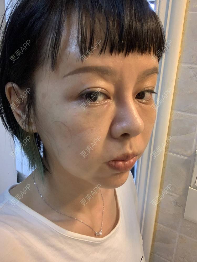 更美 - 衣衣丫丫的埋线提升经验 | 埋线提升 | 重庆