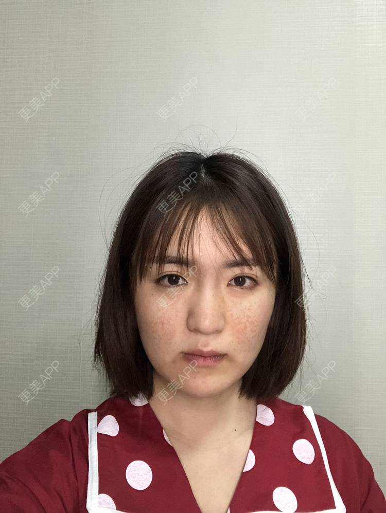 更美 - 华雄伟的激光淡斑经验 | 激光淡斑 | 武汉