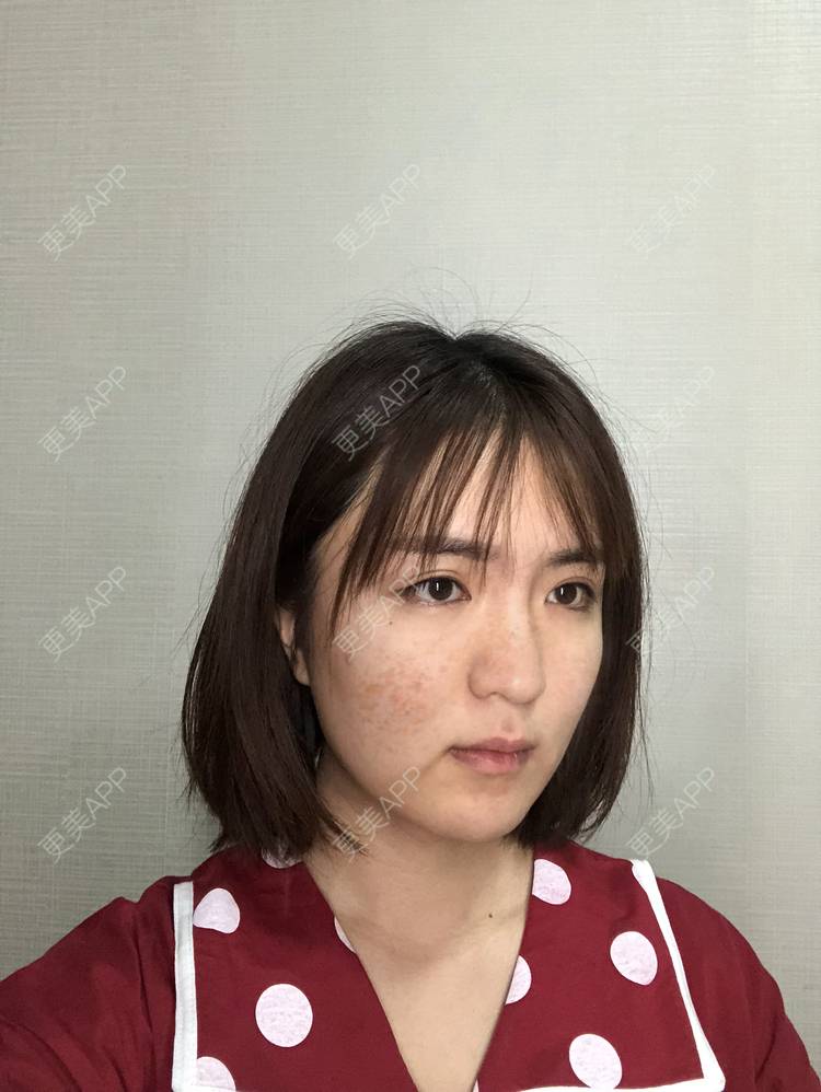 更美 - 华雄伟的激光淡斑经验 | 激光淡斑 | 武汉
