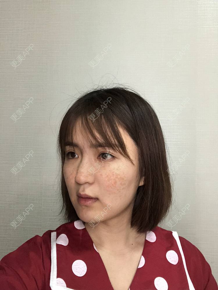 更美 - 华雄伟的激光淡斑经验 | 激光淡斑 | 武汉