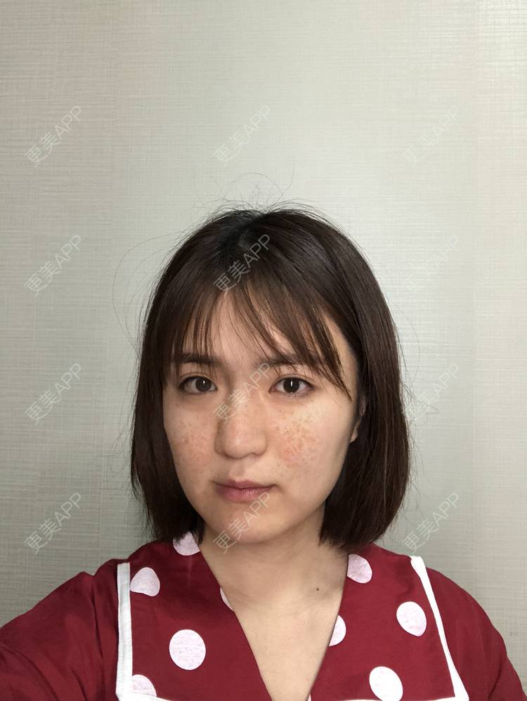 更美 - 华雄伟的激光淡斑经验 | 激光淡斑 | 武汉