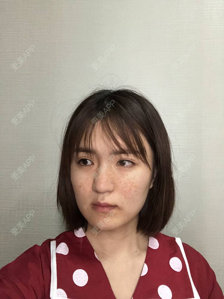 更美 - 华雄伟的激光淡斑经验 | 激光淡斑 | 武汉