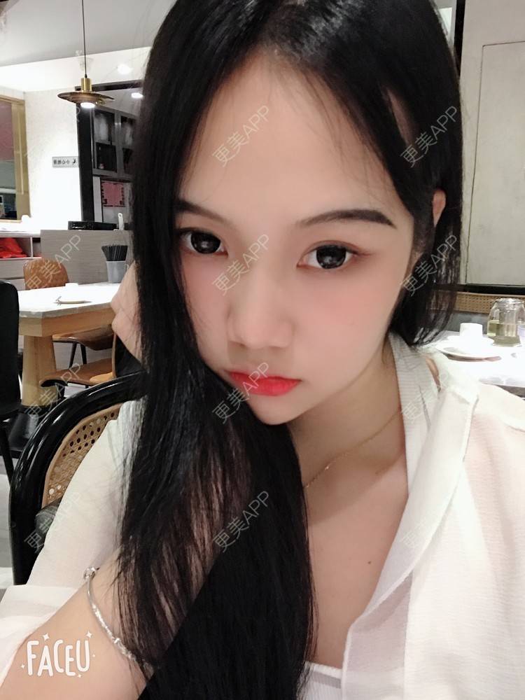 更美 - 更美用户IHPVyjEmt4的双眼皮经验 | 双眼皮 | 深圳