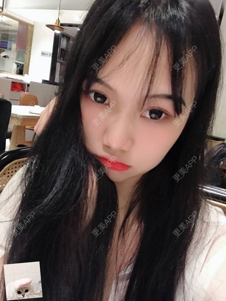 更美 - 更美用户IHPVyjEmt4的双眼皮经验 | 双眼皮 | 深圳