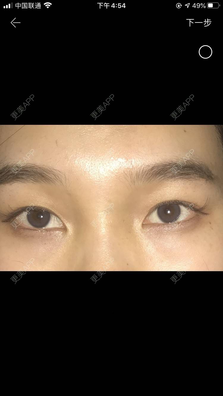 更美 - 更美用户IHPVyjEmt4的双眼皮经验 | 双眼皮 | 深圳